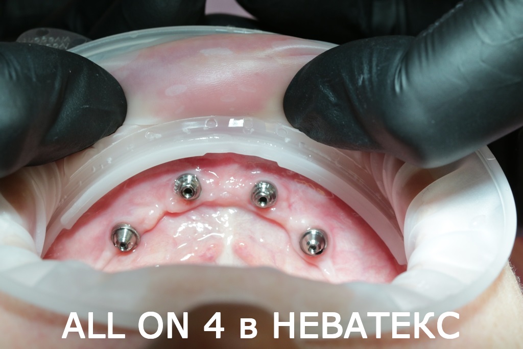 Так выглядят зубы за один день в процессе операции All on 4 зубы за один день